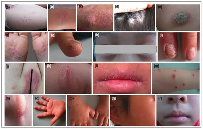Себорейный дерматит у детей - причины, симптомы и лечение в клинике «Будь  Здоров»