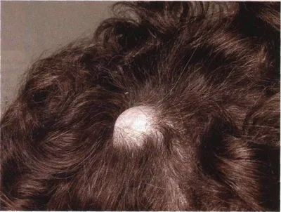 Псориаз волосистой части головы: средства и методы лечения и ухода