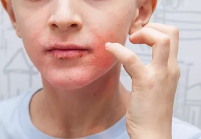 Почему сохнут губы и как от этого избавиться с помощью одной процедуры |  Сеть клиник ЛИНЛАЙН