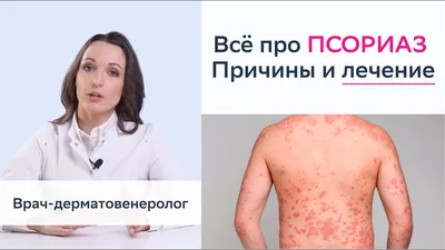 Медицинские мифы. Псориаз – экспертный материал, Lahta Clinic