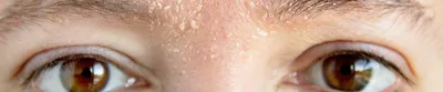 ПРОТИВОПОКАЗАНИЯ к Чистке лица👇🏼 - инфекционные заболевания -наличие ран  и ссадин на лице -розацея,дерматиты,псориаз в стадии… | Instagram
