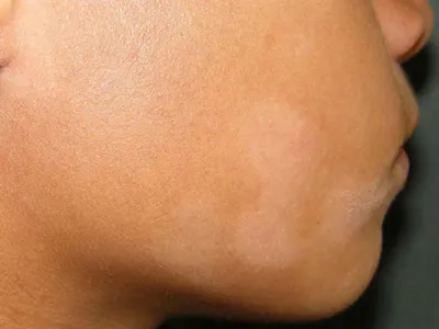 Лечение псориаза на лице