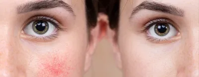 Dermaquest Skin Therapy - #ЭкземаЛица - хроническое воспалительное  заболевание кожи аллергической природы с зудом, преимущественно пузырьковой  сыпью и склонностью к рецидивам (повторениям процесса). Виды экземы,  которые чаще всего бывают на лице:⠀ ▫ #