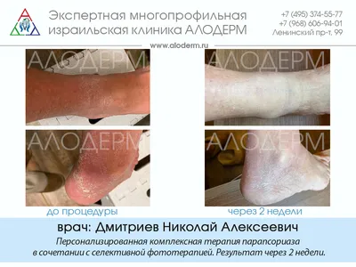 Лечение псориаза на лице в Москве | Клиника АЛОДЕРМ , Москва
