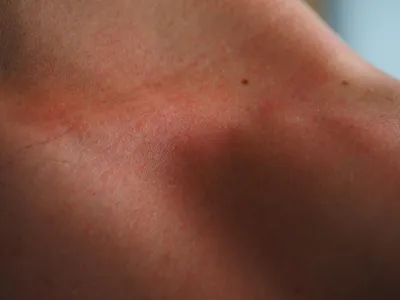 Шелушение кожи - причины появления, симптомы заболевания, диагностика и  способы лечения