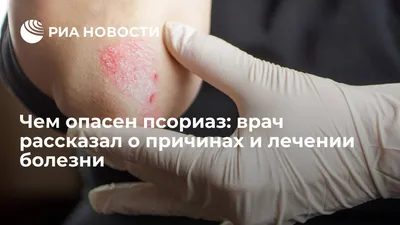 Помогает ли загар при псориазе, рассказала казахстанцам дерматолог