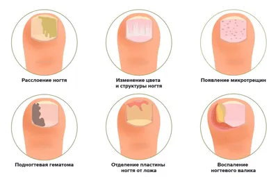 Псориаз на ногтях рук: симптомы, причины и лечение