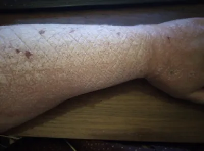 псориаз на ноге на белом фоне Стоковое Фото - изображение насчитывающей  дерматология, врач: 232031690