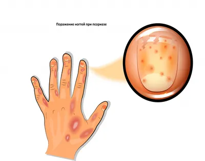 Псориаз Ногтей — стоковые фотографии и другие картинки Ноготь на руке -  Ноготь на руке, Псориаз, Болезнь - iStock