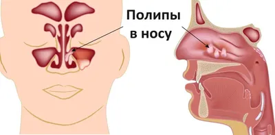 Голова больного с красной аллергической реакцией на кожу лица, покраснение  и пилинг псориаза на носу, лбу и щеках, сезонные проблемы с кожей, вид  сбоку, белый фон стоковое фото ©worklater 289617110