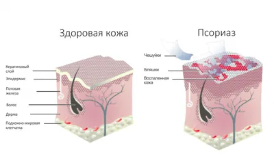 Челябинка рассказала о том, как живет с псориазом - 16 ноября 2020 - 74.ru