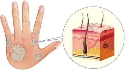Псориаз: причины, симптомы, признаки, виды, как выглядит, как вылечить,  заразен ли