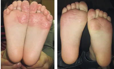 Псориаз в ноге стоковое изображение. изображение насчитывающей дерматит -  91802209
