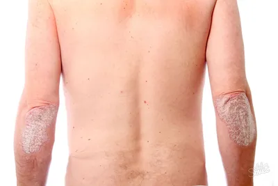 Знаки на теле или как выглядит псориаз. | Эксперт кожа | Дзен