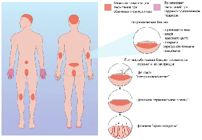 Псориаз на половых органах - Vitimed | Лечение в домашних условиях