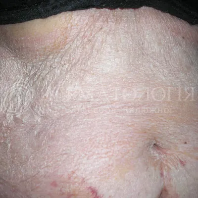 Псориаз на голове - как и чем лечить болезнь волосистой части кожи, как он  выглядит, лучшие средства для лечения симптомов, фото