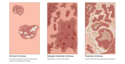 Разновидности псориаза: признаки заболевания и способы лечения