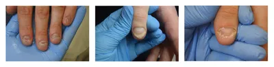 Эффективное лечение псориаза ногтей в клинике ПсорМак в Москве
