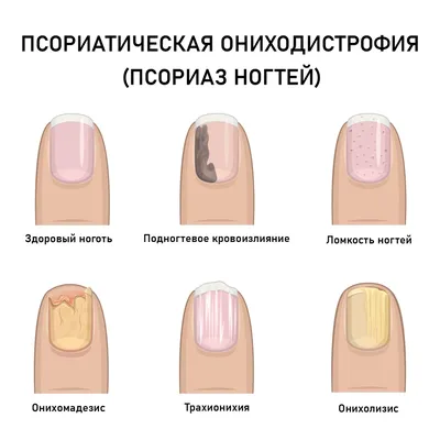 Лечение псориаза ногтей в Москве – лечение ногтей на руках и ногах в  клинике MedNail