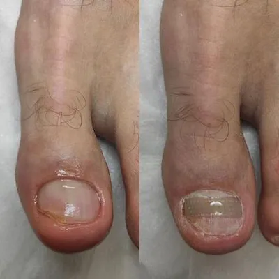 Псориаз ногтей – это форма псориаза, при которой поражаются ногти на руках  и ногах. Под ногтевой пластиной не редко образуется… | Instagram