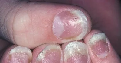 Podolоg Olga - Псориаз ногтей — одна из наиболее тяжелых форм кожного  хронического заболевания псориаз. Псориаз ногтей встречается довольно  редко, он затрагивает ногтевые пластины на руках и ногах, иногда псориазом  поражается и кожа,