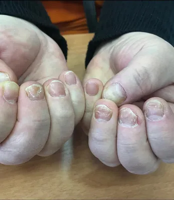 Псориаз ногтей — это особая форма псориаза, при которой поражаются ногти на  руках и/или ногах. Врачи называют этот вид болезни… | Instagram