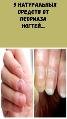 Зачастую псориаз ногтей путают с грибком, но опытный специалист способ... |  TikTok