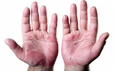 ПОДОЛОГ◾️ПЕДИКЮР◾️КАМЕНСК-УР on Instagram: \"Псориаз ногтей, как вылечить?  ↘️ результат клиента на фото Бывает не только на коже, но и поражает  ногтевую пластину рук/ног как дополнительно к уже имеющимся бляшкам на  теле, либо