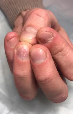 Псориаз ногтей на руках и ногах, согласно статистике, встречается примерно  у 80-90% больных псориазом. Это может быть самостоятельное… | Instagram