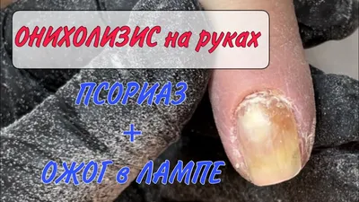 Грибок ногтей — Derma.ua