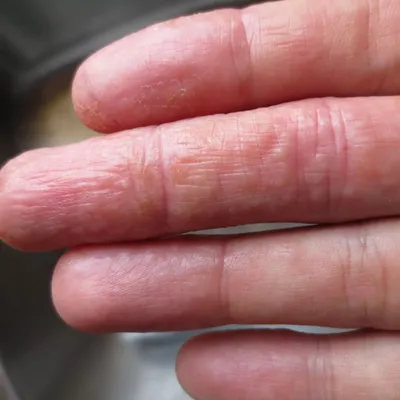 Что такое онихолизис, причины и лечение онихолизиса ногтей на руках и ногах  | STALEKS