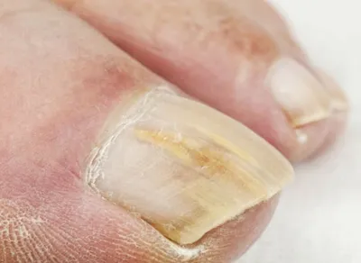 Лечение ониходистрофии ногтей в Днепре - Подо Центр Ольги Пашиной
