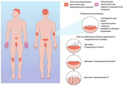 Типы псориаза | ВКонтакте
