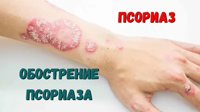 Псориаз - причины, симптомы, диагностика, лечение и профилактика