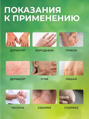 Профессиональное лечение псориаза в Казани – прием дерматолога | Клиника  МЕДЕЛ