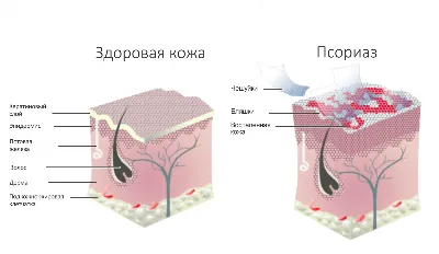 Псориаз: причины, симптомы, лечение» — создано в Шедевруме