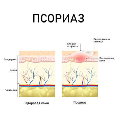 Псориаз: эффективное лечение, мазь от псориаза, псориаз на голове и других  частях тела