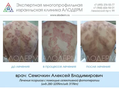 Причина возникновения псориаза. Факторы обострения | Псориазу ВСЁ или всё о  PSORIAZE | Дзен