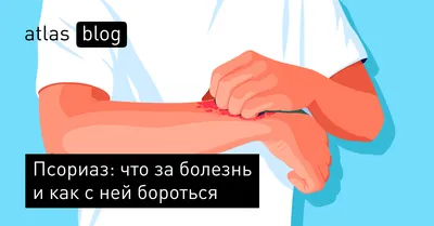 Плазмаферез при псориазе: показания и противопоказания. Делать плазмаферез  в Москве