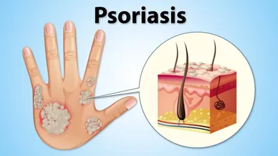 Что важно знать о псориазе: симптомы, какие факторы провоцируют псориаз,  как лечат псориаз, методы и препараты, что нужно знать о псориазе,  профилактика