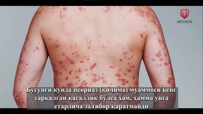 Лечение псориаза (чешуйчатого лишая) в Киеве — Derma.ua