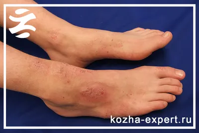 Файл:Psoriasis2010.JPG — Википедия