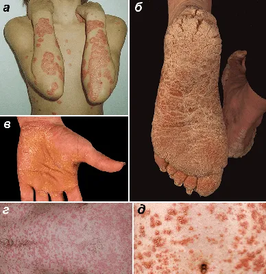Ключевые аспекты псориаза у детей - Журнал Доктор Ру