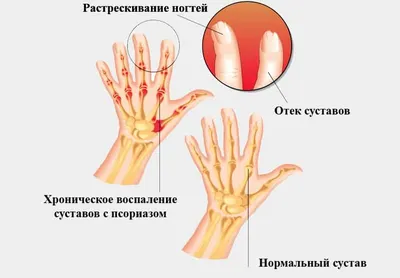 Псориатический артрит - описание, цены, прием в Центре остеопатии