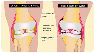 Псориаз - что это, симптомы, лечение и профилактика - FitoBlog