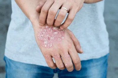 Себорейный дерматит | Аллергология и Иммунология