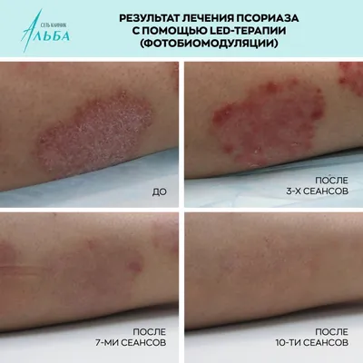 Обострение псориаза у детей | Pharmacosmetica.ru | Дзен