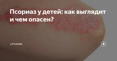 Псориаз у детей: как выглядит и чем опасен? | Littleone | Дзен