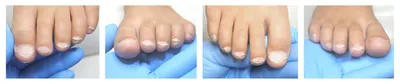 Торпидное течение псориаза ногтей у детей ✓ Авторские статьи Клиники  подологии Полёт в Москве