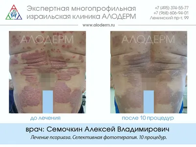 Псориаз - консультация дерматолога онлайн iDerma